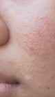 exfoliator II